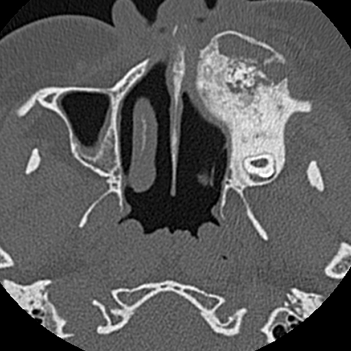 File:Ameloblastic fibro-odontoma (Radiopaedia 18843-18780 C 28).jpg