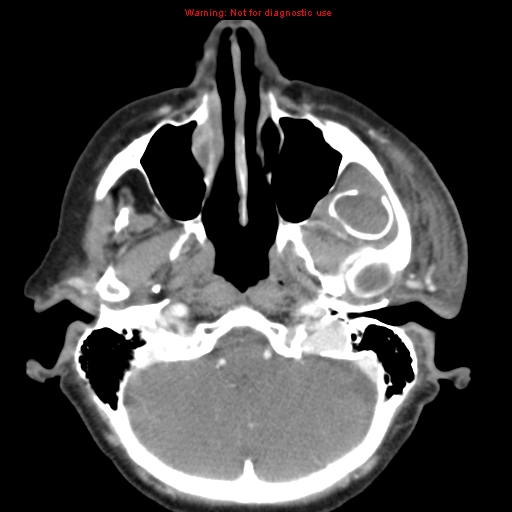 Ameloblastoma (Radiopaedia 27437-27631 A 14).jpg