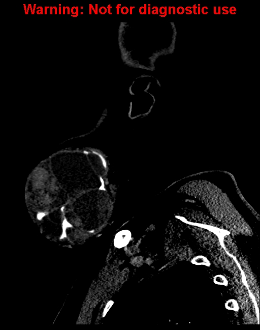 Ameloblastoma (Radiopaedia 33126-34164 F 10).jpg