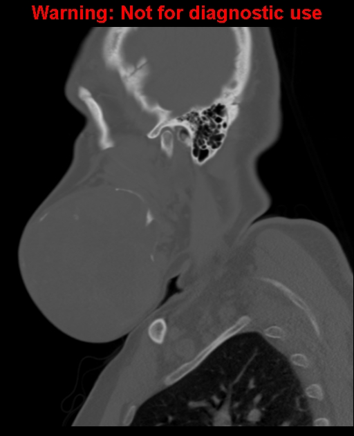 Ameloblastoma (Radiopaedia 33126-34164 Sagittal bone window 20).jpg