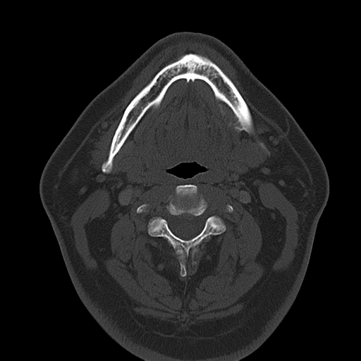 Ameloblastoma (Radiopaedia 38520-40623 Axial bone window 35).png