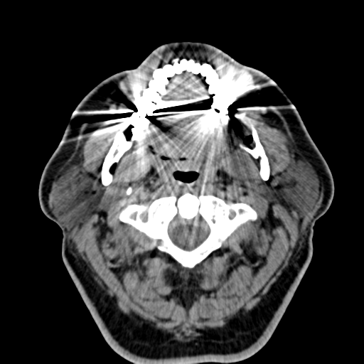 Ameloblastoma (Radiopaedia 38520-40623 Axial non-contrast 26).png