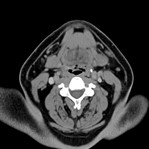 Ameloblastoma (Radiopaedia 38520-40623 Axial non-contrast 40).png