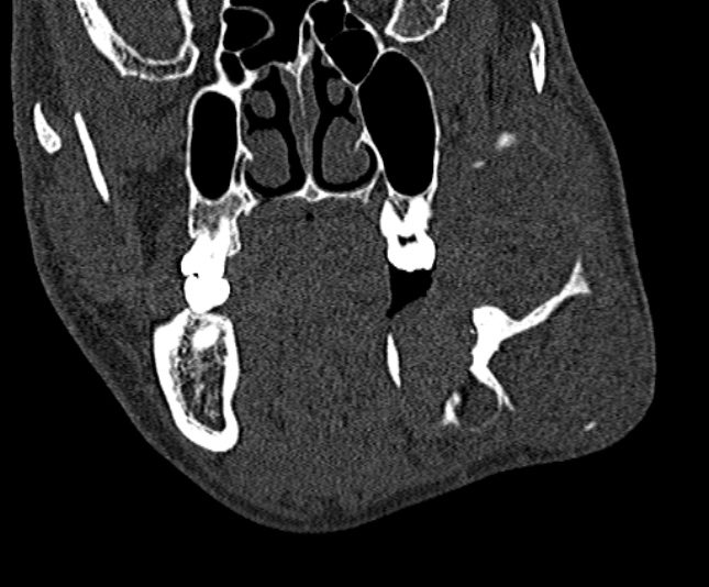 Ameloblastoma (Radiopaedia 51921-57766 Coronal bone window 102).jpg