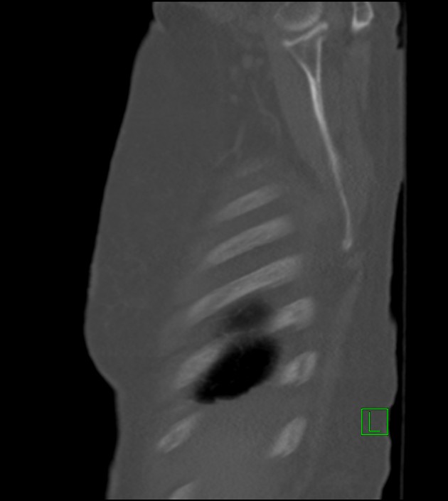 Amiodarone deposition in the liver (Radiopaedia 77587-89780 Sagittal bone window 87).jpg