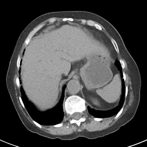 File:Ampullary adenocarcinoma (Radiopaedia 34013-35237 Axial non-contrast 9).png