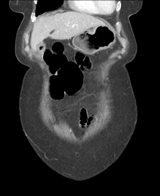Ampullary adenocarcinoma (Radiopaedia 34013-35237 E 12).png