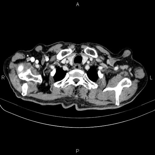 Ampullary adenocarcinoma (Radiopaedia 86093-102033 B 13).jpg