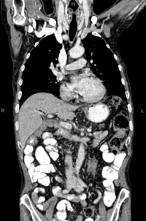 Ampullary adenocarcinoma (Radiopaedia 86093-102033 D 26).jpg