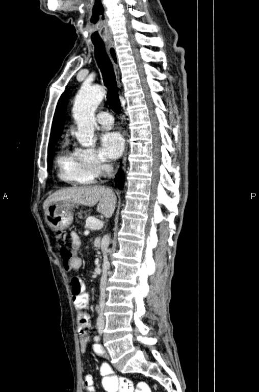 Ampullary adenocarcinoma (Radiopaedia 86093-102033 E 45).jpg