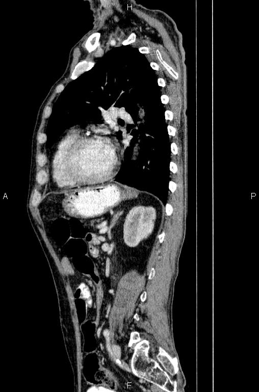 Ampullary adenocarcinoma (Radiopaedia 86093-102033 E 61).jpg