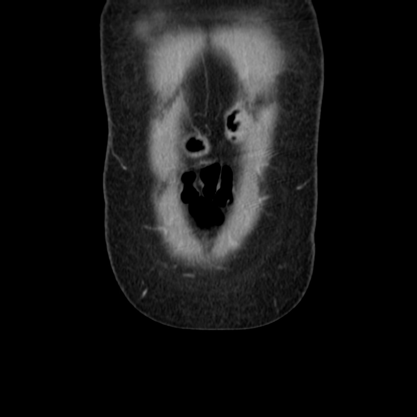 Ampullary tumor (Radiopaedia 22787-22816 E 7).jpg