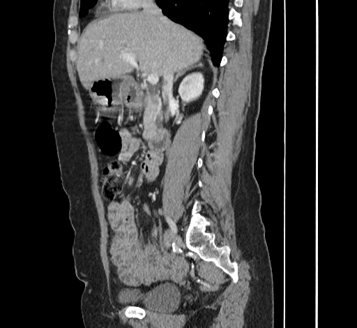 File:Ampullary tumor (Radiopaedia 60333-67998 C 22).jpg