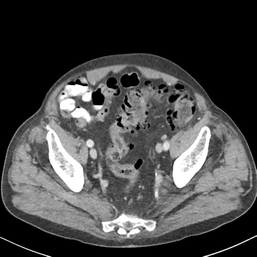File:Amyand hernia (Radiopaedia 39300-41547 A 59).png
