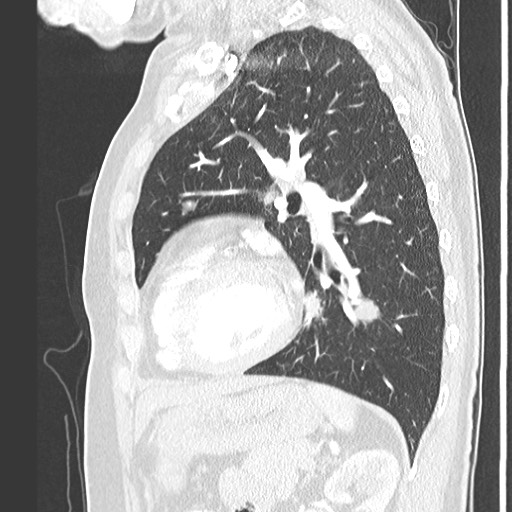 Amyloidosis - bronchial and diffuse nodular pulmonary involvement (Radiopaedia 60156-67745 Sagittal lung window 61).jpg
