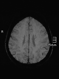 File:Amyotrophic lateral sclerosis (Radiopaedia 70821-81017 Axial SWI minIP 35).jpg