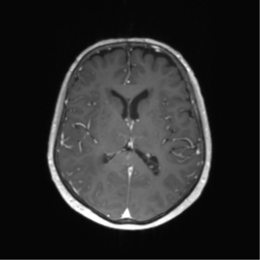 File:Anaplastic astrocytoma (Radiopaedia 86943-103160 Axial T1 C+ 34).png