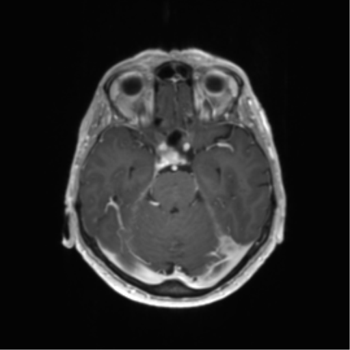 File:Anaplastic astrocytoma (Radiopaedia 86943-103160 Axial T1 C+ 6).png