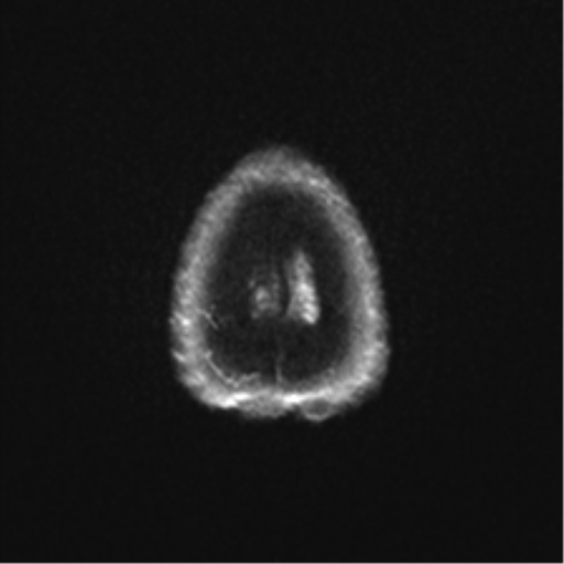Anaplastic astrocytoma - thalamic glioma (Radiopaedia 59709-67115 Axial DWI 35).png