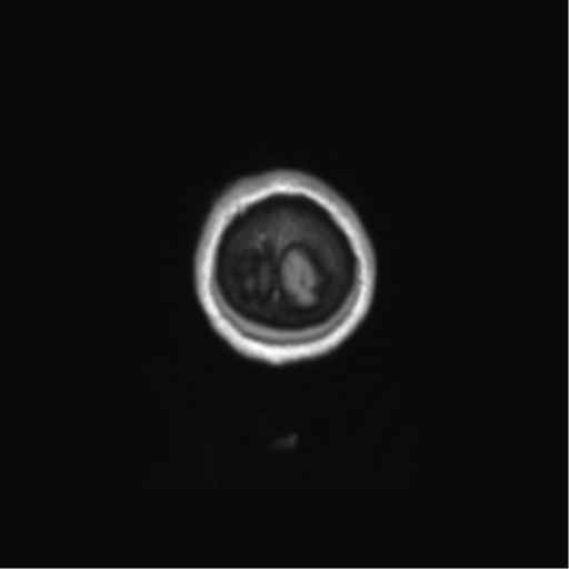 Anaplastic astrocytoma IDH mutant (Radiopaedia 50046-55341 Coronal T1 3).png