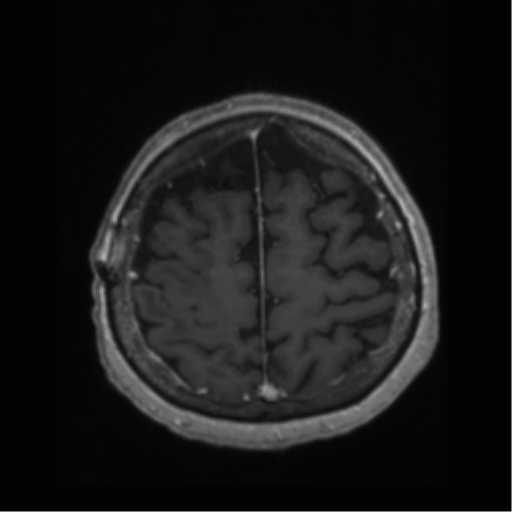 File:Anaplastic astrocytoma IDH wild-type (pseudoprogression) (Radiopaedia 42209-45277 Axial T1 C+ 103).png