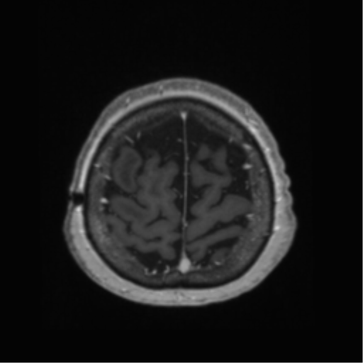 Anaplastic astrocytoma IDH wild-type (pseudoprogression) (Radiopaedia 42209-45278 Axial T1 C+ 132).png