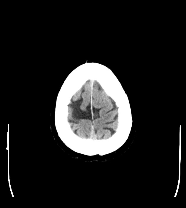 Anaplastic oligodendroglioma (Radiopaedia 79571-92753 Axial non-contrast 48).jpg