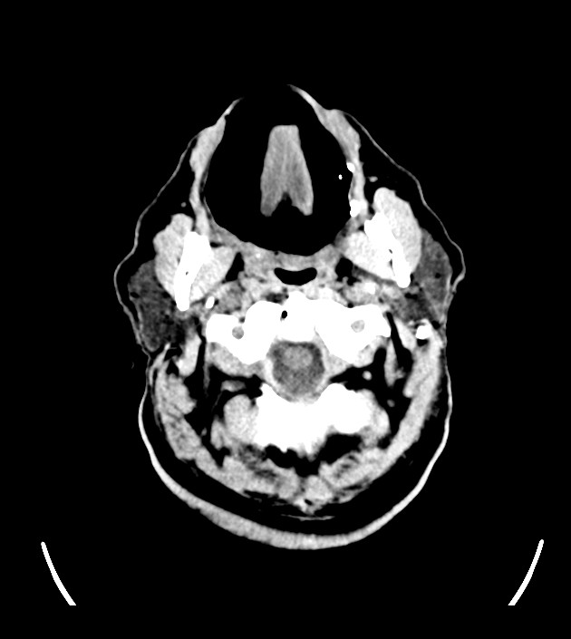 Anaplastic oligodendroglioma (Radiopaedia 79571-92755 Axial non-contrast 3).jpg