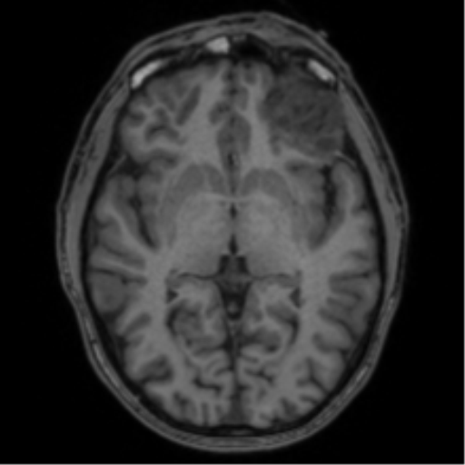 Anaplastic oligodendroglioma with skull fracture (Radiopaedia 74831-85845 Axial T1 30).png