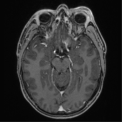 Anaplastic oligodendroglioma with skull fracture (Radiopaedia 74831-85845 Axial T1 C+ fat sat 23).png