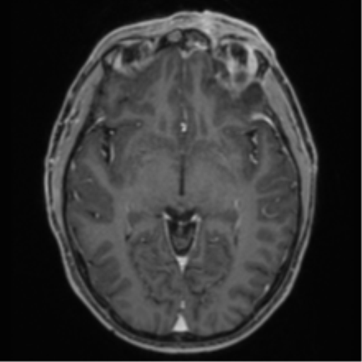 Anaplastic oligodendroglioma with skull fracture (Radiopaedia 74831-85845 Axial T1 C+ fat sat 28).png