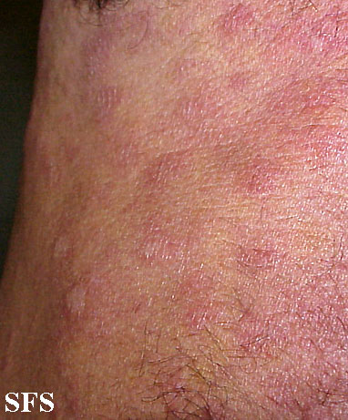Anetoderma Jadassohn Pellizari (Dermatology Atlas 4).jpg