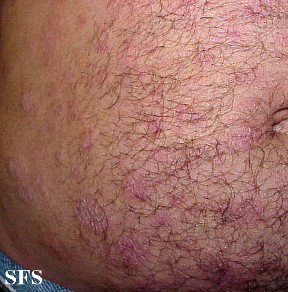 Anetoderma Jadassohn Pellizari (Dermatology Atlas 5).jpg