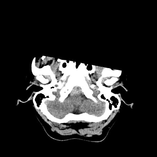 File:Aneursym related subarachnoid hemorrhage with hydrocephalus (Radiopaedia 45105-49083 Axial non-contrast 3).jpg
