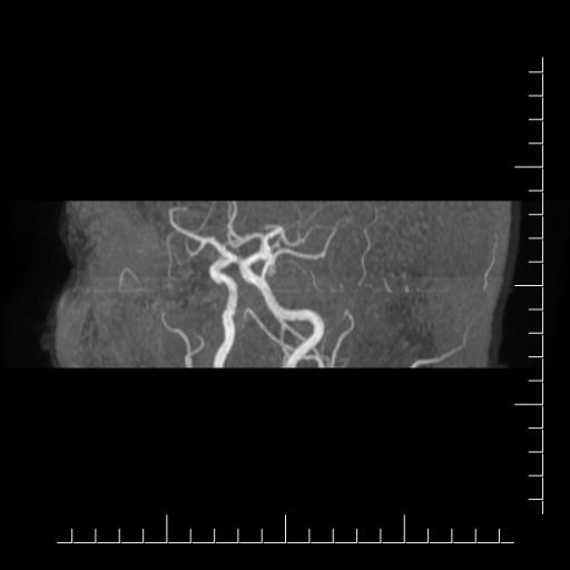 File:Aneurysm of posterior communicating artery (Radiopaedia 20188-20163 MRA 6).jpg