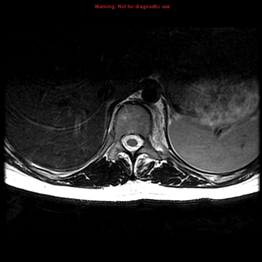 File:Aneurysmal bone cyst (Radiopaedia 9419-10103 Axial T2 15).jpg