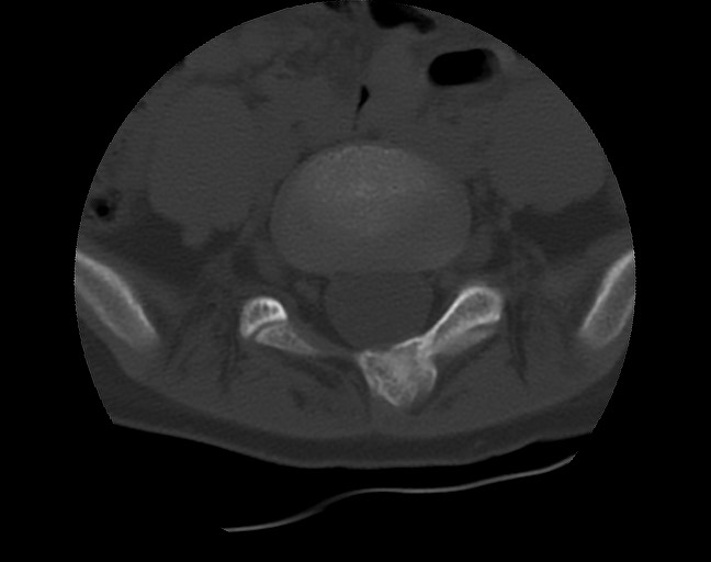 Aneurysmal bone cyst - sacrum (Radiopaedia 65190-74195 Axial bone window 13).jpg