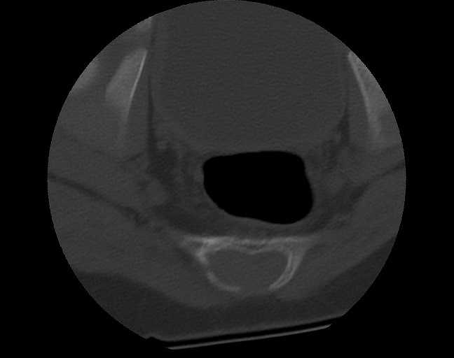Aneurysmal bone cyst - sacrum (Radiopaedia 65190-74195 Axial bone window 40).jpg