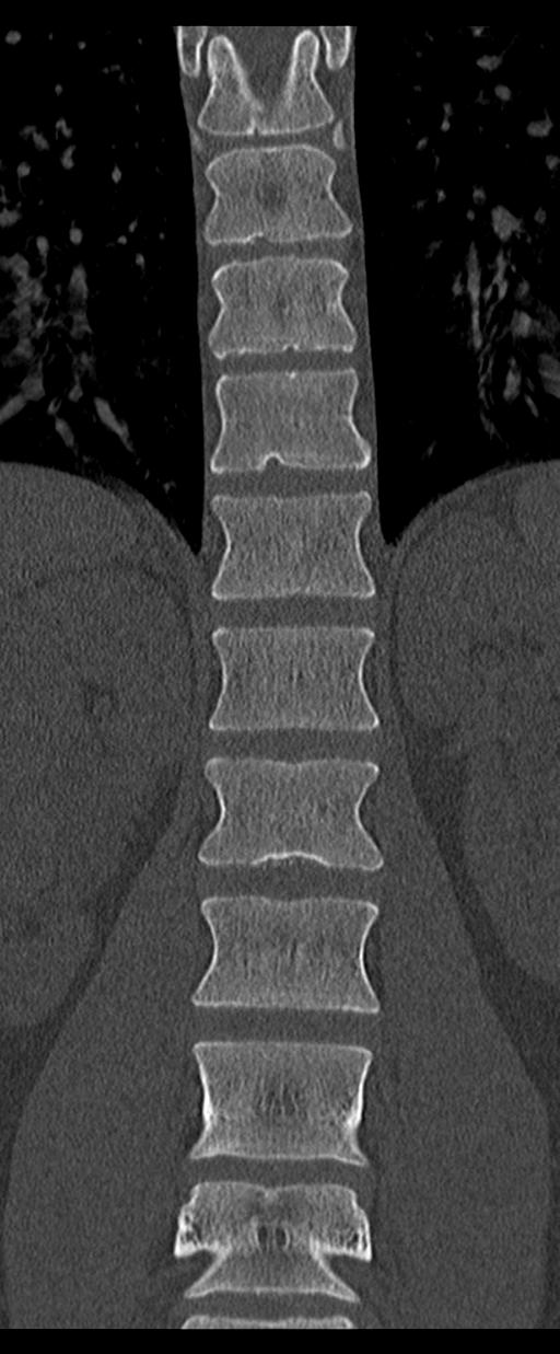 Aneurysmal bone cyst T11 (Radiopaedia 29294-29721 Coronal bone window 29).jpg