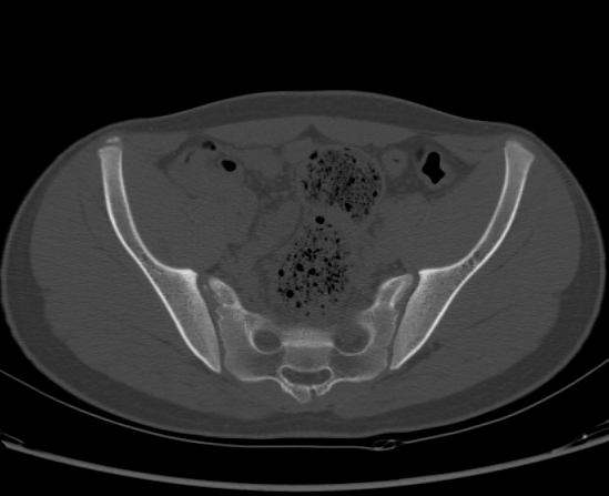 File:Aneurysmal bone cyst of ischium (Radiopaedia 25957-26094 Axial bone window 30).png