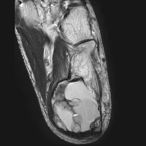 File:Aneurysmal bone cyst of the calcaneus (Radiopaedia 60669-68420 Axial T2 8).jpg