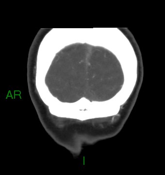 Aneurysmal subarachnoid hemorrhage with intra-axial extension (Radiopaedia 84371-99732 C 12).jpg