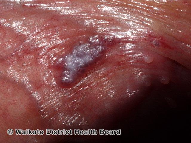 File:Angiokeratoma of Fordyce on vulva (DermNet NZ angiokeratoma-23).jpg