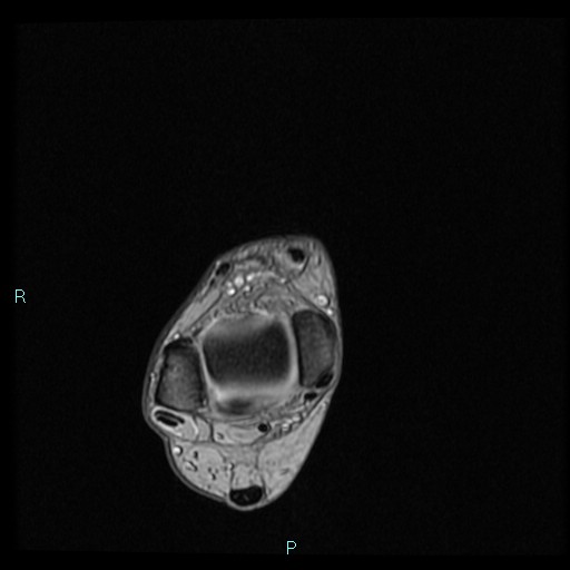 Ankle ganglion cyst (Radiopaedia 62809-71162 Axial Gradient Echo 66).jpg