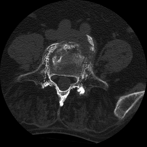 Ankylosing spondylitis complicated by fracture-dislocation (Radiopaedia 33583-34674 Axial non-contrast 122).jpg