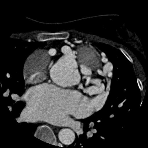 File:Anomalous left coronary artery from the pulmonary artery (ALCAPA) (Radiopaedia 40884-43586 A 23).jpg