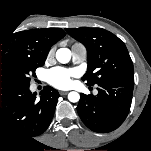 Anomalous left coronary artery from the pulmonary artery (ALCAPA) (Radiopaedia 70148-80181 A 66).jpg