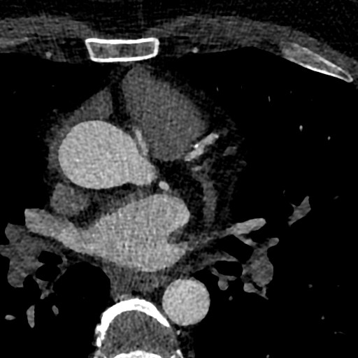 File:Anomalous origin of the left coronary artery with malignant course (Radiopaedia 77842-90126 C 31).jpeg