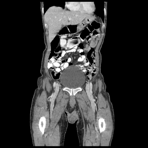 Anorectal carcinoma (Radiopaedia 44413-48064 B 13).jpg