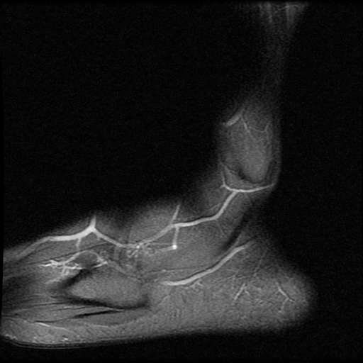File:Anterior calcaneal process fracture (Radiopaedia 74654-85611 Sagittal PD fat sat 20).jpg